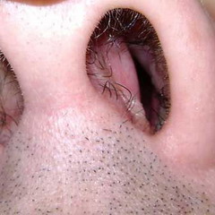 Искривление перегородки носа у мужчины